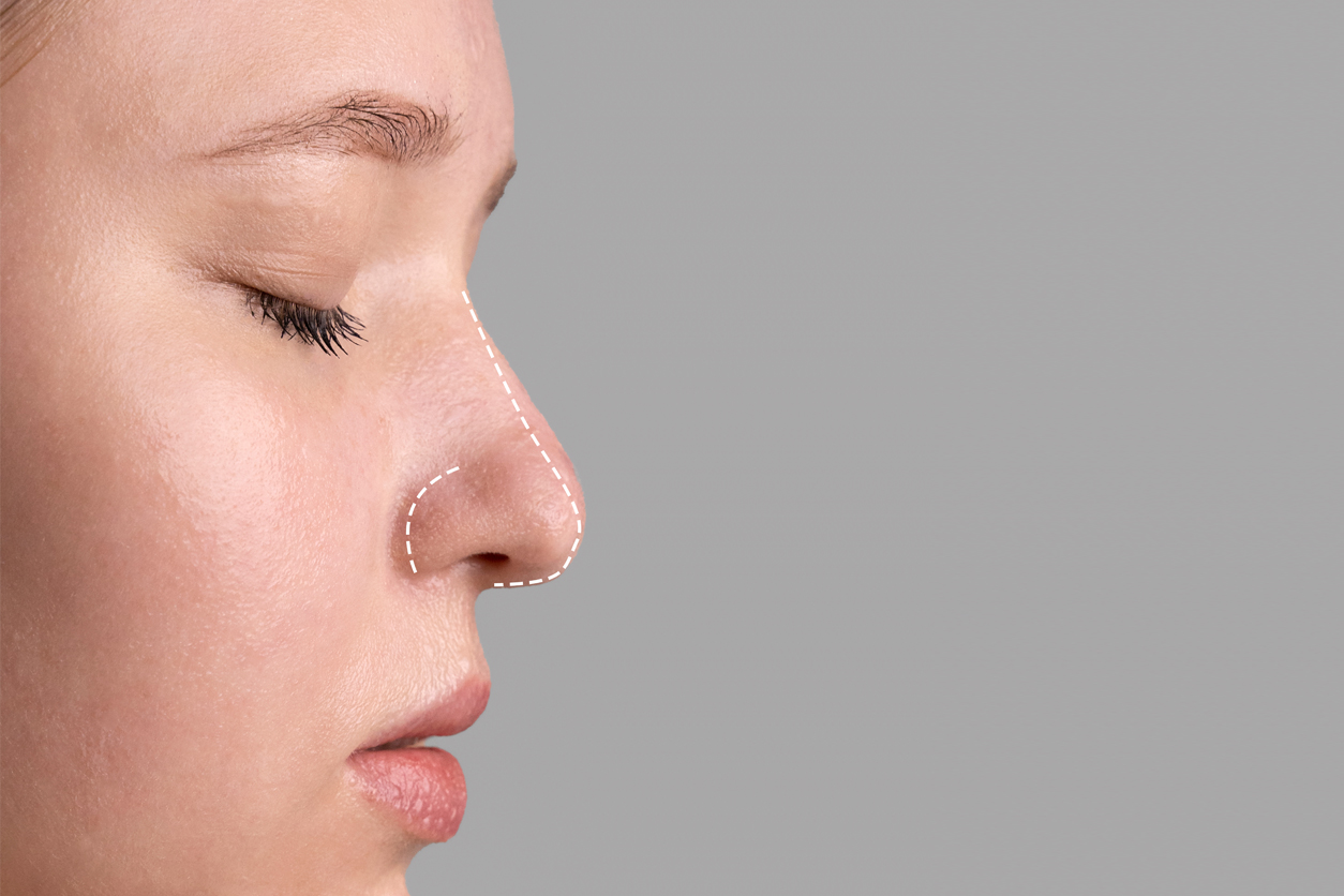 İzmir Burun Estetiği (Rinoplasti)