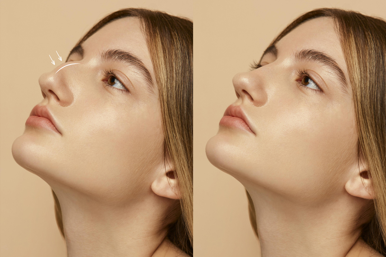 Doğal ve Estetik Burun Yapısı